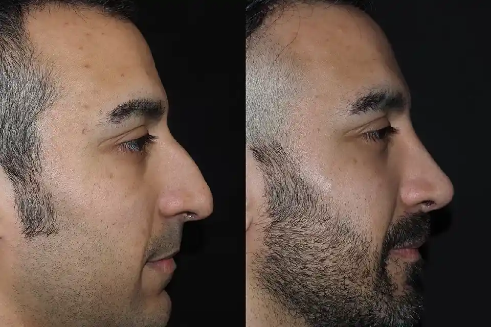 Nose Job in Dubai